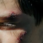 wound